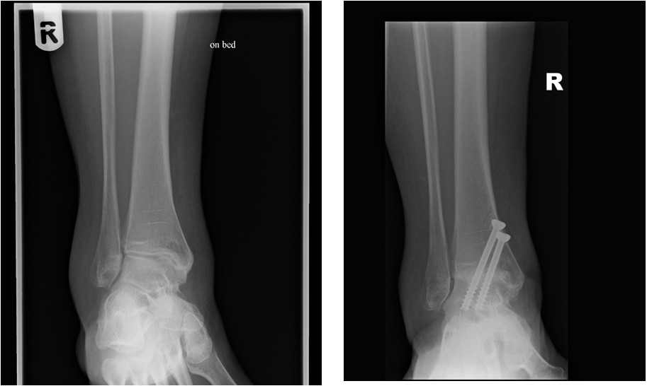 ankle arthrodesis xray