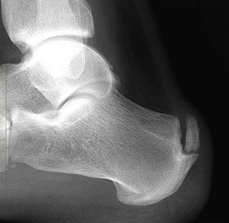 xray showing haglund's deformity