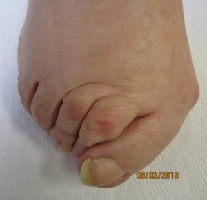 deformity of the hallux valgus