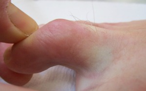 hammer toe