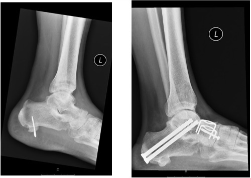 hindfoot fusion xray